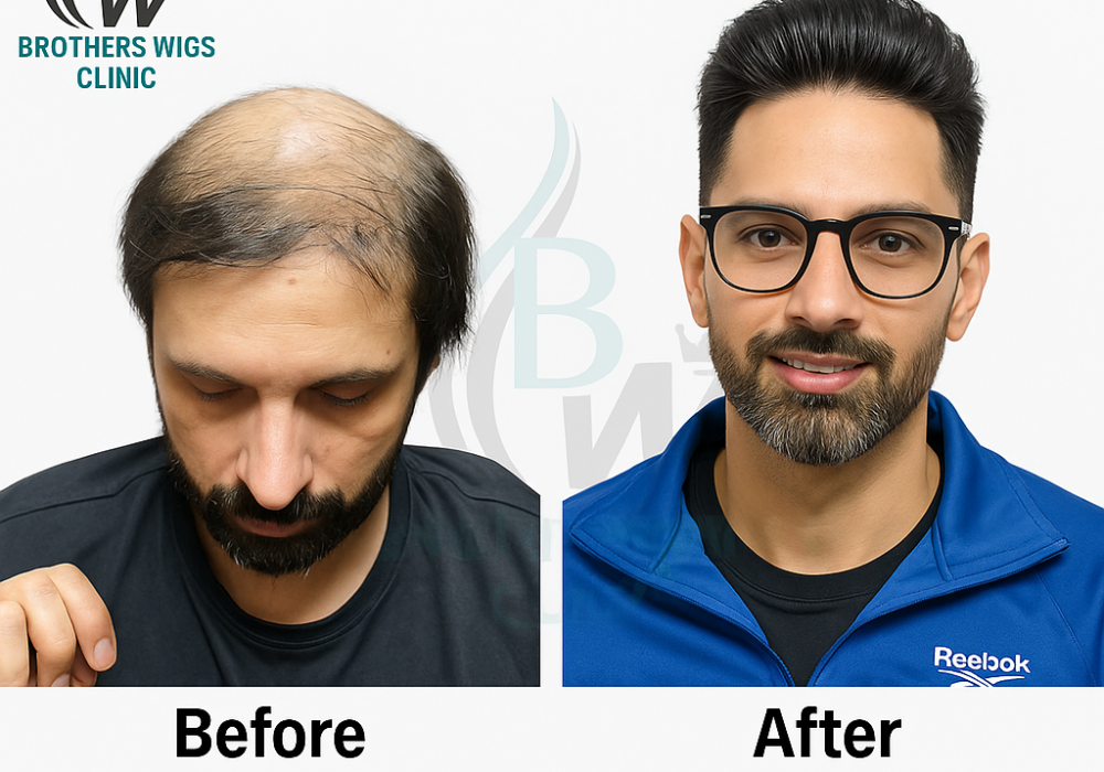 680cf4f9b82f86306d734019UndetectableTransformationwithHairPatch (2)